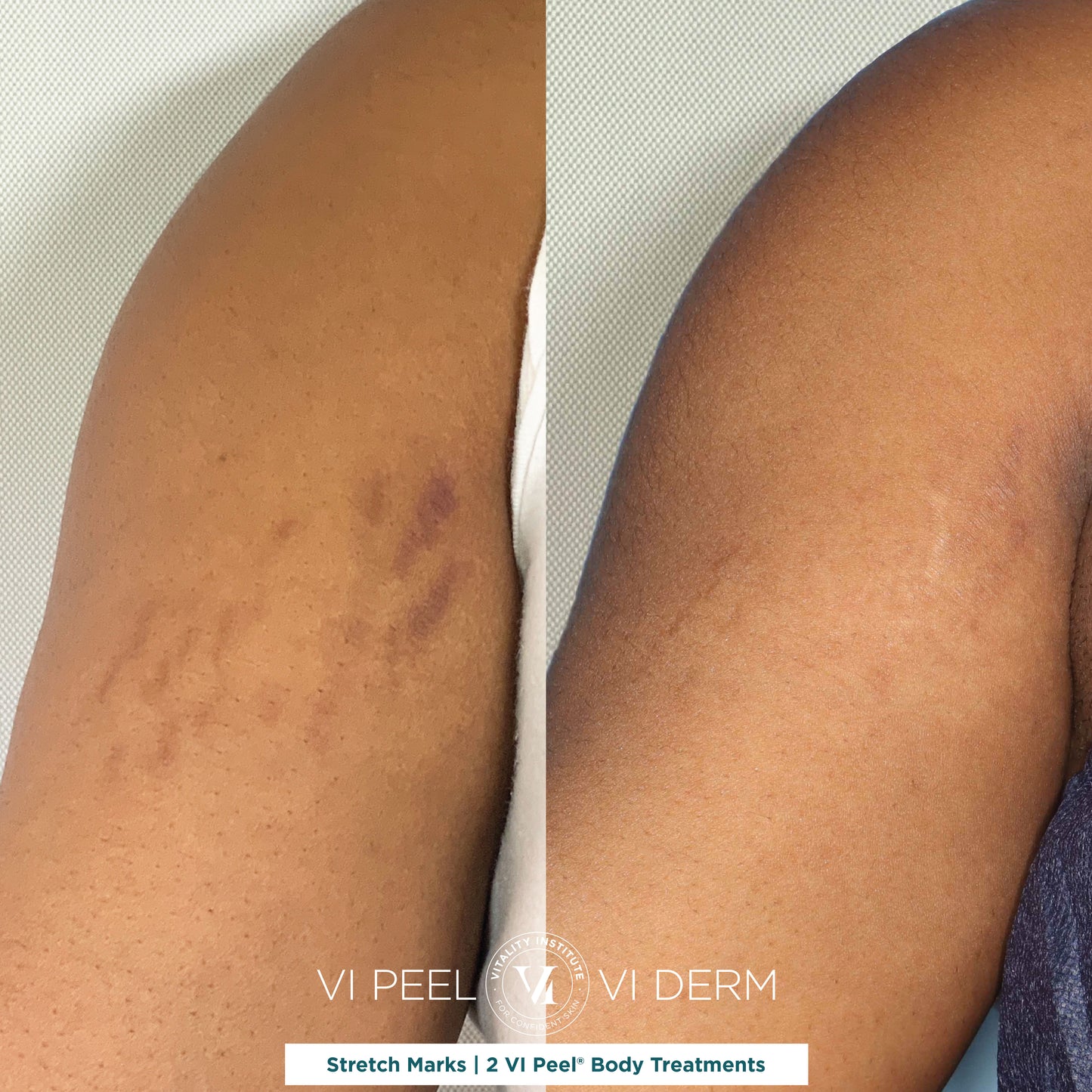 VI Body Peel Small Area