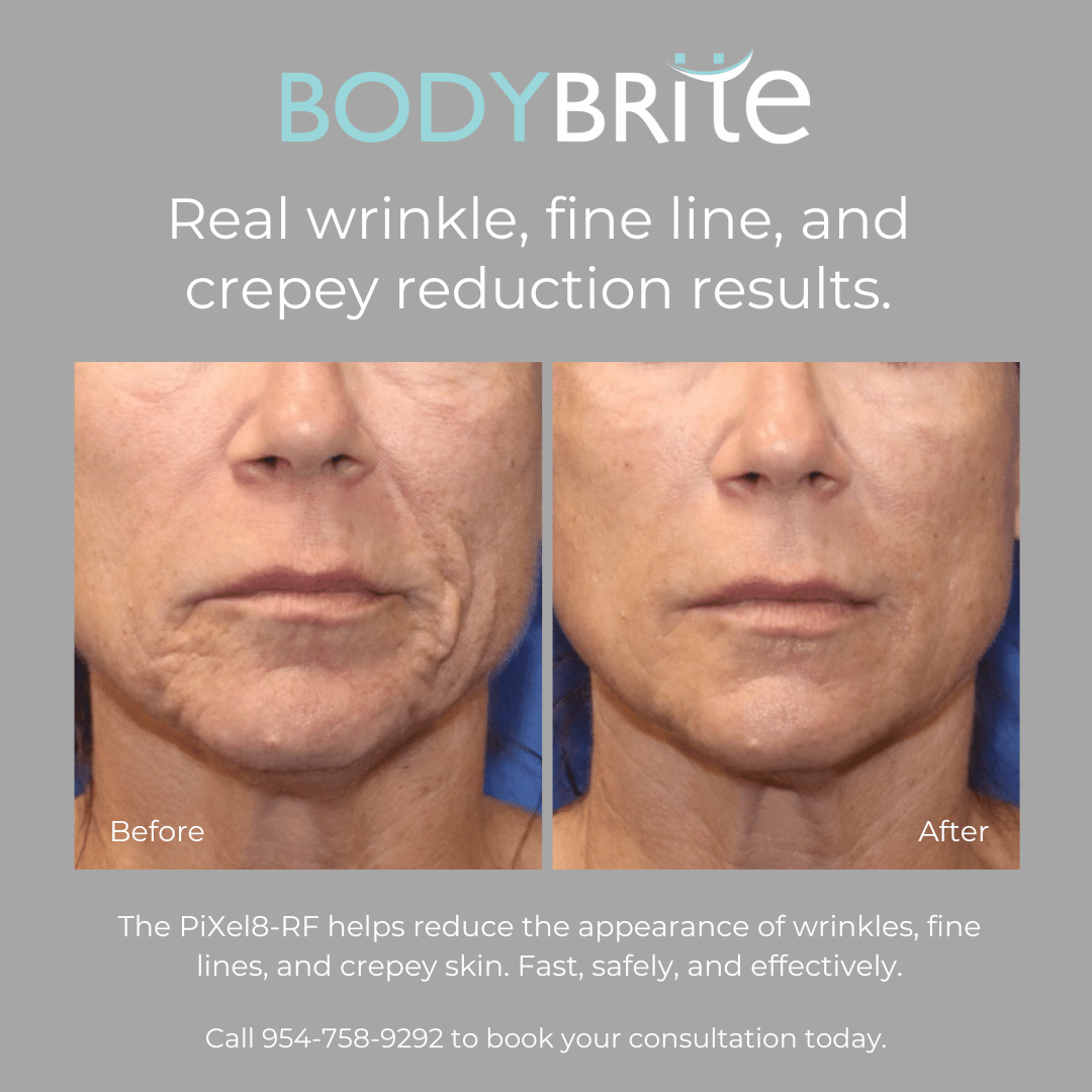 Day 4 Skintastic Savings - Buy 1 RF Microneedling Treatment for Face and Receive 50% OFF A Second Treatment