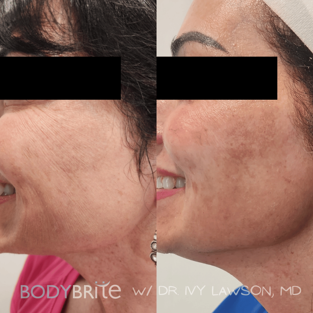 Day 4 Skintastic Savings - Buy 1 RF Microneedling Treatment for Face and Receive 50% OFF A Second Treatment