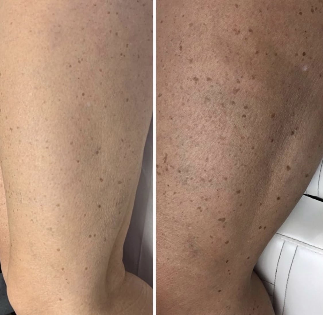 IPL Skin Rejuvenation - 3 or 6 Sessions for Legs