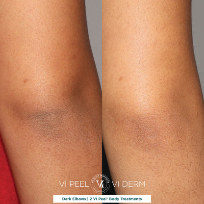 VI Body Peel - Small Area