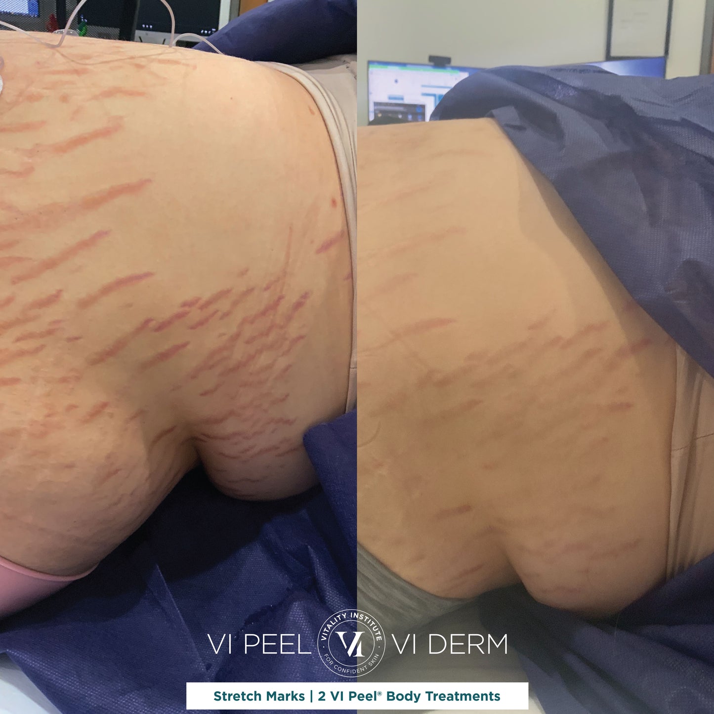VI Body Peel Large Area