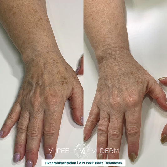 VI Body Peel - Small Area