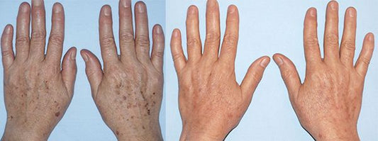 Cuerpo de rejuvenecimiento de la piel con IPL: 40 % de descuento en 3 sesiones para áreas pequeñas