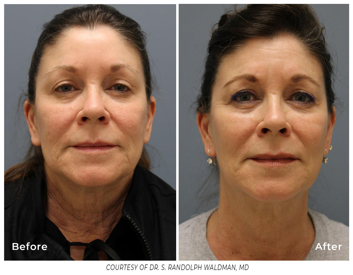 Pixel8 RF Microneeling Packages for Face Only  - Package of 3