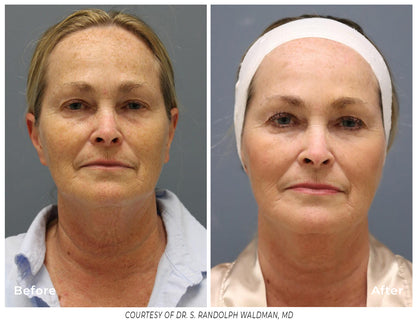 Pixel8 RF Microneeling Packages for Face Only  - Package of 3