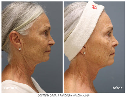 Pixel8 RF Microneeling Packages for Face Only  - Package of 3