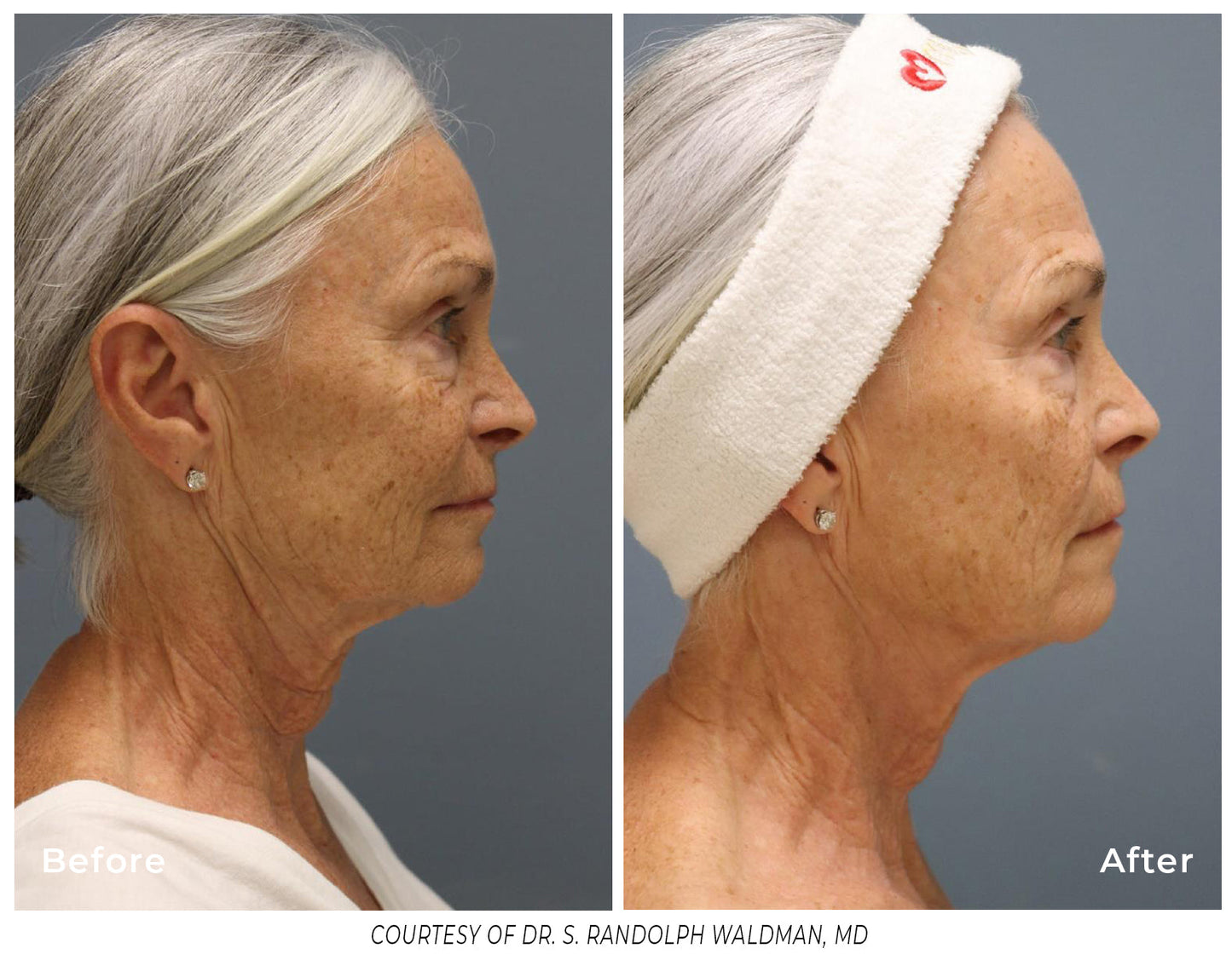 Pixel8 RF Microneeling - Buy 1 RF Microneedling Treatment for Face and Receive Neck for FREE