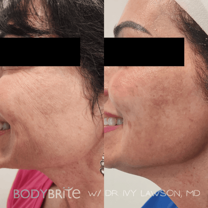 Day 4 Skintastic Savings -  Buy 1 RF Microneedling Treatment for Face and Receive 50% OFF A Second Treatment