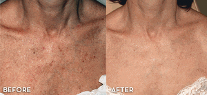 IPL Skin Rejuvenation Body - 40% OFF 6 Sessions for Small Area
